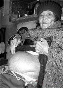 woman_delivers_a_stone_baby_after_60_year_pregnancy-gidibase